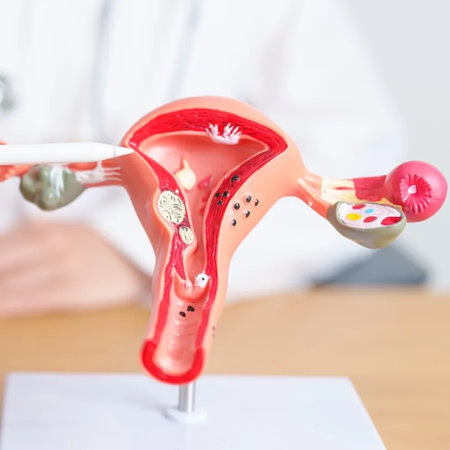 Endometriose baarmoeder model