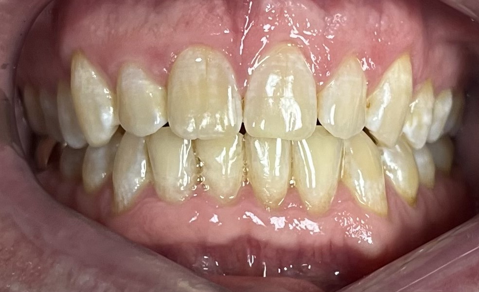 ballwin cosmetic dentist