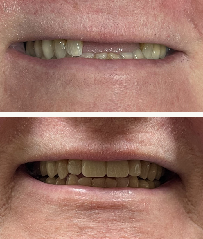 Ballwin dental implants