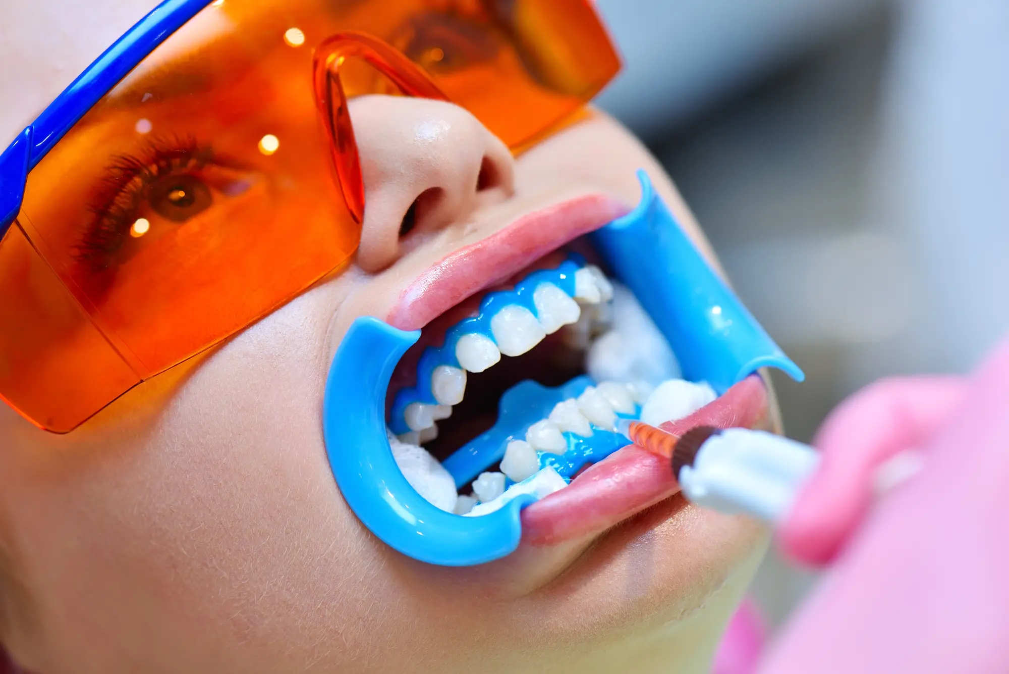 Why Worthington Patients Love Pairing Invisalign with Teeth Whitening