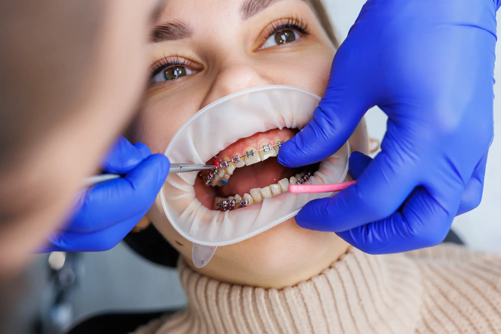 What Is Considered an Orthodontic Emergency? Get the Facts and Know When to Act