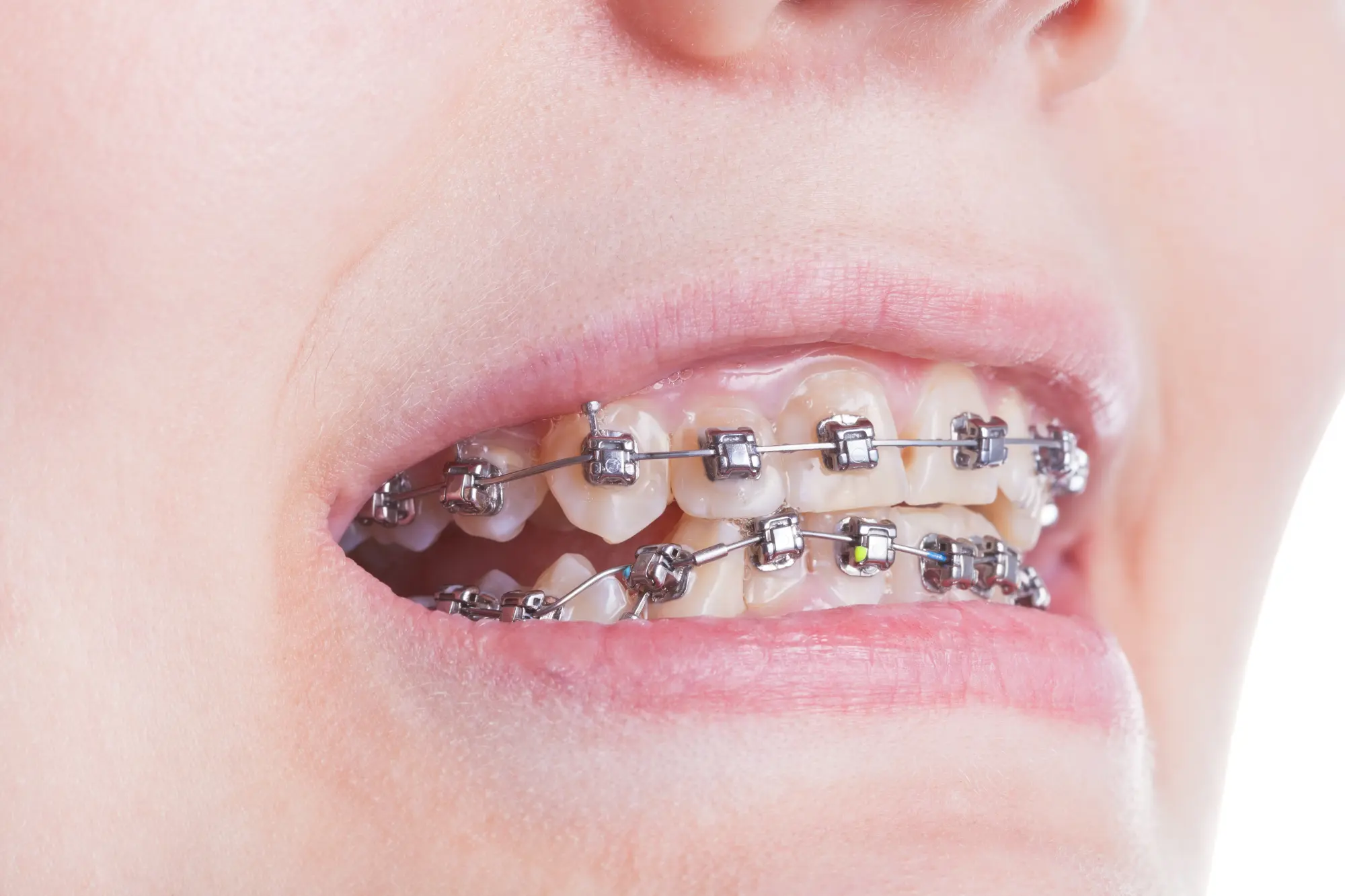 Damon System Braces: Faster Results and Fewer Appointments with Self-Ligating Tech