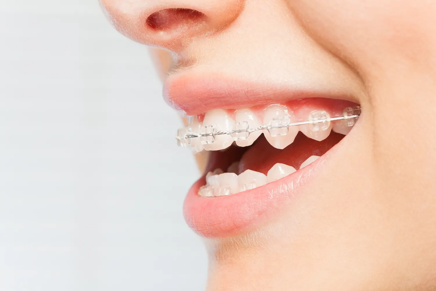 Ceramic Braces: The Aesthetic Alternative for a Discreet Smile Transformation