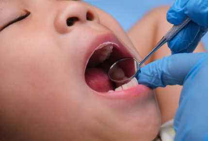 What Causes Cavities in Children?