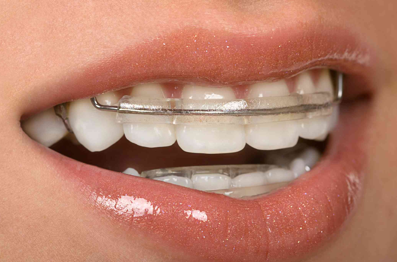 Retainer?