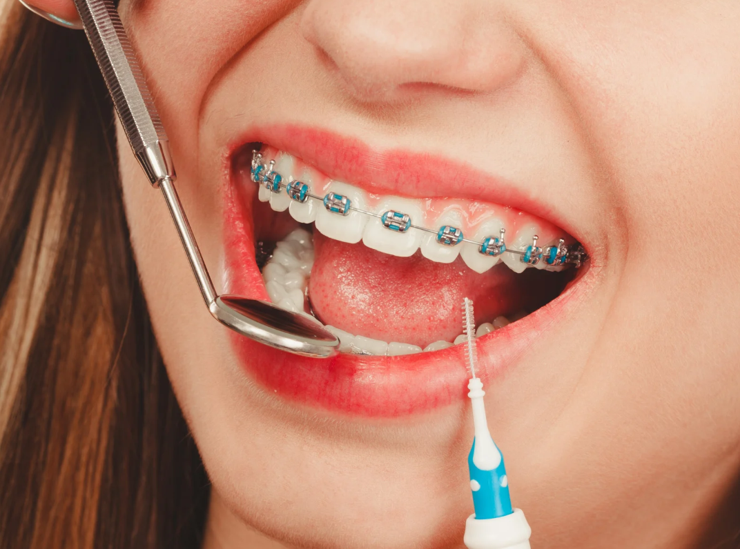 What Is Included in a Braces Treatment Fee?