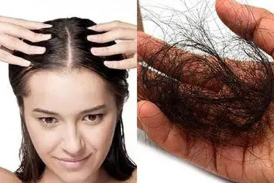 Tóc rụng nhiều