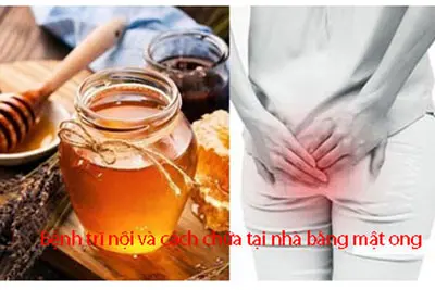 Bệnh trĩ nội và cách chữa tại nhà bằng mật ong
