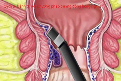 Cách trị bệnh trĩ với phương pháp quang đông hồng ngoại
