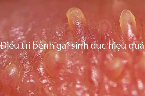 Cách chữa gai sinh dục nữ hiệu quả và an toàn