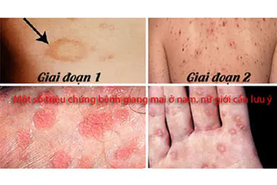 Triệu chứng bệnh giang mai ở nam, nữ giới cần lưu ý