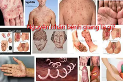 Nguyên nhân bệnh giang là gì?