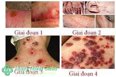 Dấu hiệu bệnh giang mai