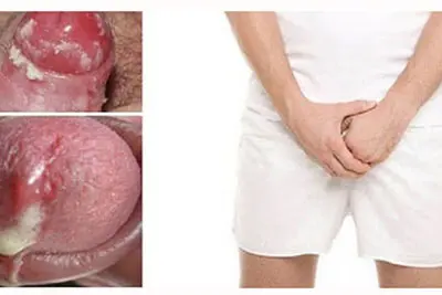 Triệu chứng của bệnh lậu ở nam giới