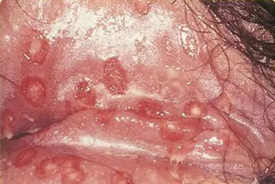 Bệnh lậu ở nữ giới