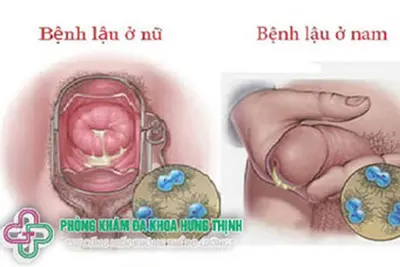 Bệnh lậu là gì?