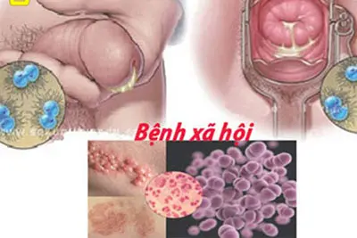 Bệnh xã hội là gì?