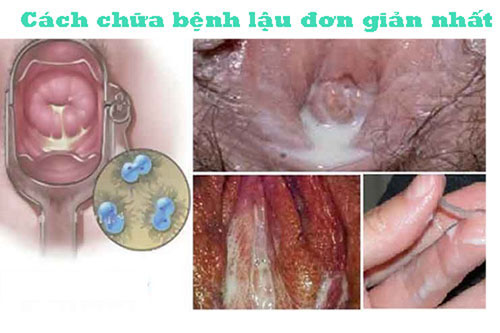 Cách chữa trị bệnh lậu đơn giản hiệu quả nhất tại nhà