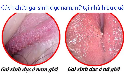 Cách chữa gai sinh dục tại nhà