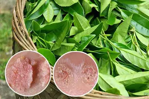 Cách chữa gai sinh dục nam, nữ tại nhà bằng lá trà xanh
