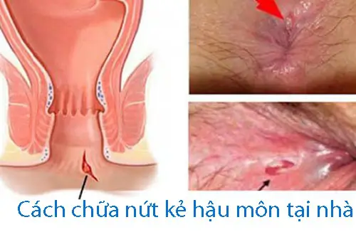 Cách chữa trị nứt kẽ hậu môn tại nhà hiệu quả