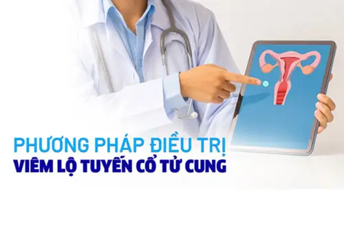 Điều trị viêm cổ tử cung triệt để