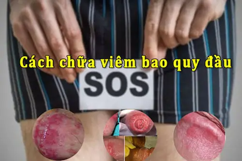 Cách chữa viêm bao quy đầu tại nhà