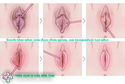 Cách thu nhỏ âm đạo đơn giản, an toàn nhất tại nhà