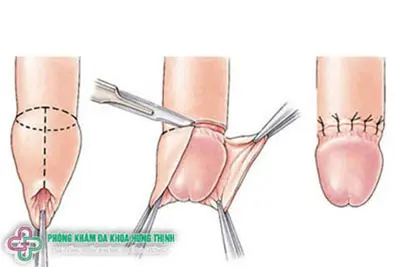 Cách lột bao quy đầu an toàn đúng cách 