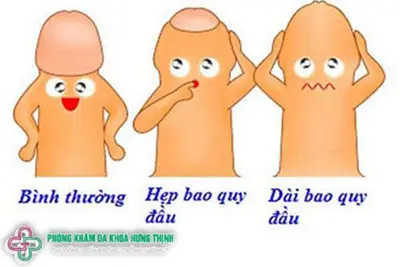 Chưa lột bao quy đầu gây ra những tác hại gì?