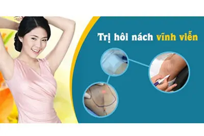 Chữa hôi nách vĩnh viễn
