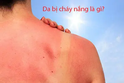 Da bị cháy nắng là gì?