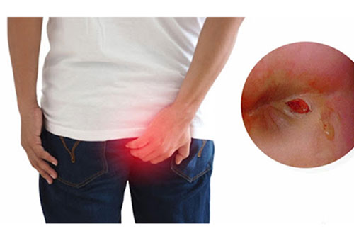 Tình trạng chảy dịch nhầy ở hậu môn
