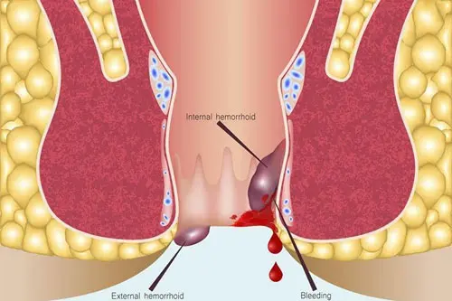 Xuất hiện máu đông trong búi trĩ