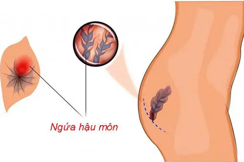 Ngứa hậu môn