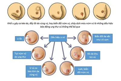 Dấu hiệu ung thư vú cần thăm khám ngay
