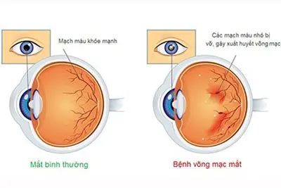 Giảm thị lực, mù lòa