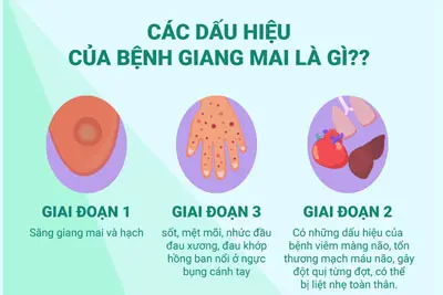 Dấu hiệu, triệu chứng bệnh giang mai thường gặp