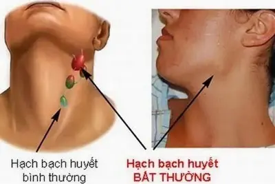 Sưng hạch bạch huyết