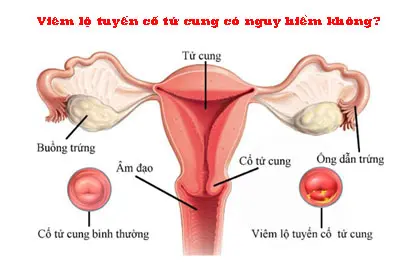 Viêm lộ tuyến cổ tử cung có nguy hiểm không?