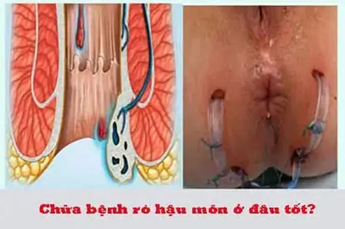 Chữa bệnh rò hậu môn ở đâu tốt nhất?