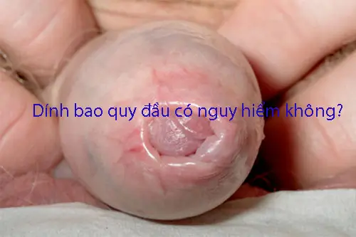 Dính bao quy đầu có nguy hiểm không?