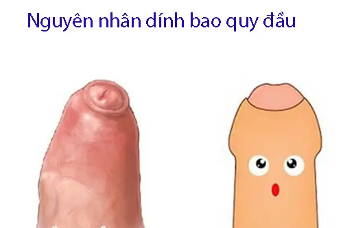 Nguyên nhân dính bao quy đầu ở nam giới