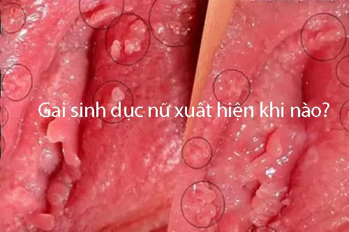 Gai sinh dục nữ xuất hiện khi nào?