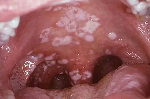 Hình ảnh bệnh lậu ở miệng