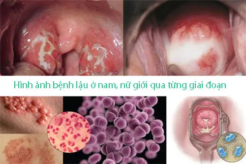 Hình ảnh bệnh lậu ở nam, nữ giới qua từng giai đoạn