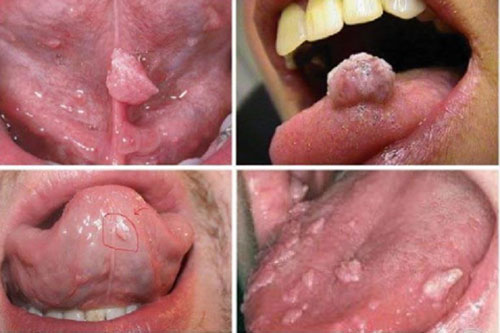 Hình ảnh của bệnh sùi mào gà ở miệng