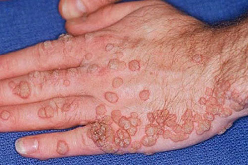 Hình ảnh bệnh sùi mào gà ở tay