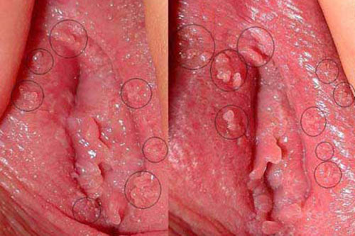 Hình ảnh của bệnh sùi mào gà ở bộ phận sinh dục nữ