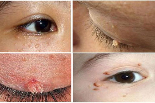 Hình ảnh của bệnh sùi mào gà ở mắt